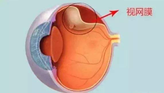 高血压性视网膜病变