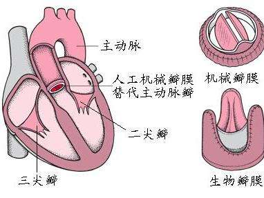 心脏瓣膜置换术