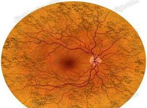 视网膜血管炎