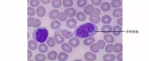 急性粒-单核细胞白血病