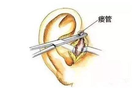 先天性耳前瘘管