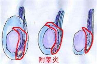 附睾炎