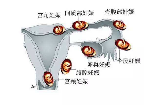 输卵管妊娠